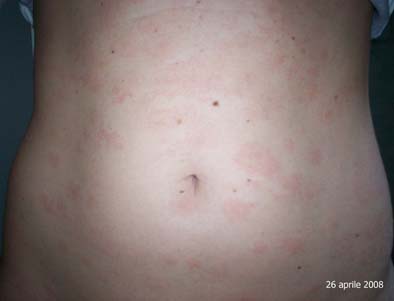 pytiriasis